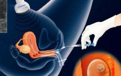 福建哪里可以做第三代试管婴儿？费用需要多少钱？